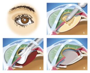 Етапи лікування катаракти